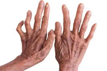 Sonhar com Lepra, tê-la, significa fortuna por meio ilícitos. Vê-la em alguém, enfermidade em pessoa íntima. Ver morrer alguém atacado por ela, significa traição.
